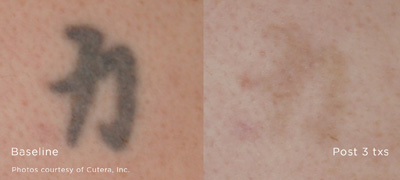 Laser Tattoo Removal Federal Way - Fewer Treatments